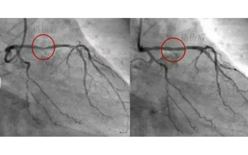 深圳市模具廠對(duì)心臟支架的關(guān)注，國(guó)產(chǎn)化的道路有多長(zhǎng)？